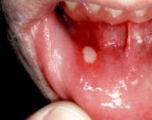 口　アフタ性の潰瘍　口内炎