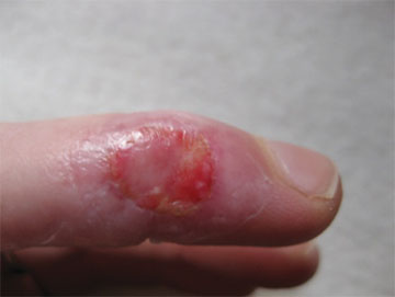 指　皮膚移植後ウィートグラス療法経過症例