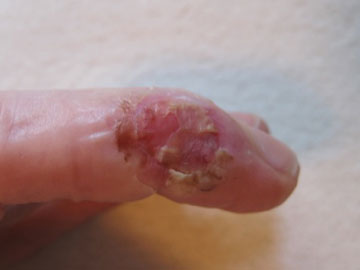指　皮膚移植後ウィートグラス療法症例