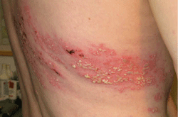 帯状疱疹　ウィートグラス療法前の背中　脇腹