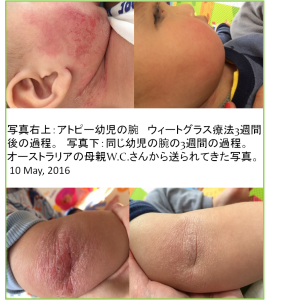 アトピー幼児　顔　肘　ウィートグラス療法回復経過例